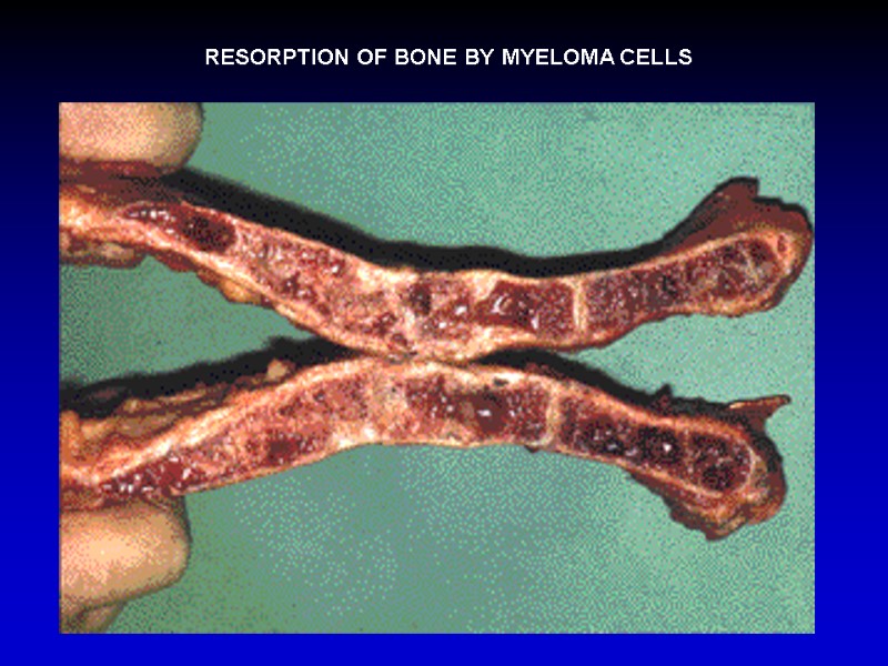 RESORPTION OF BONE BY MYELOMA CELLS